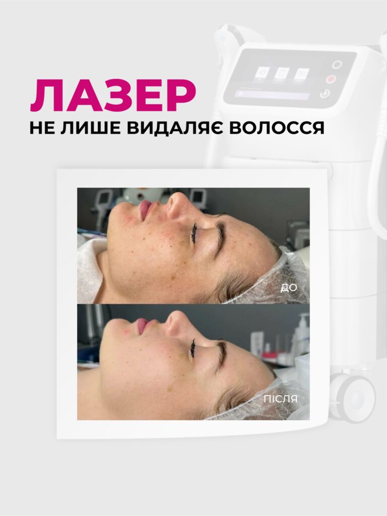13laser instagram